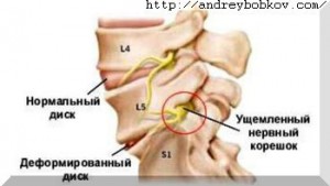 корешковый синдром при остеохондрозе шейного отдела позвоночника